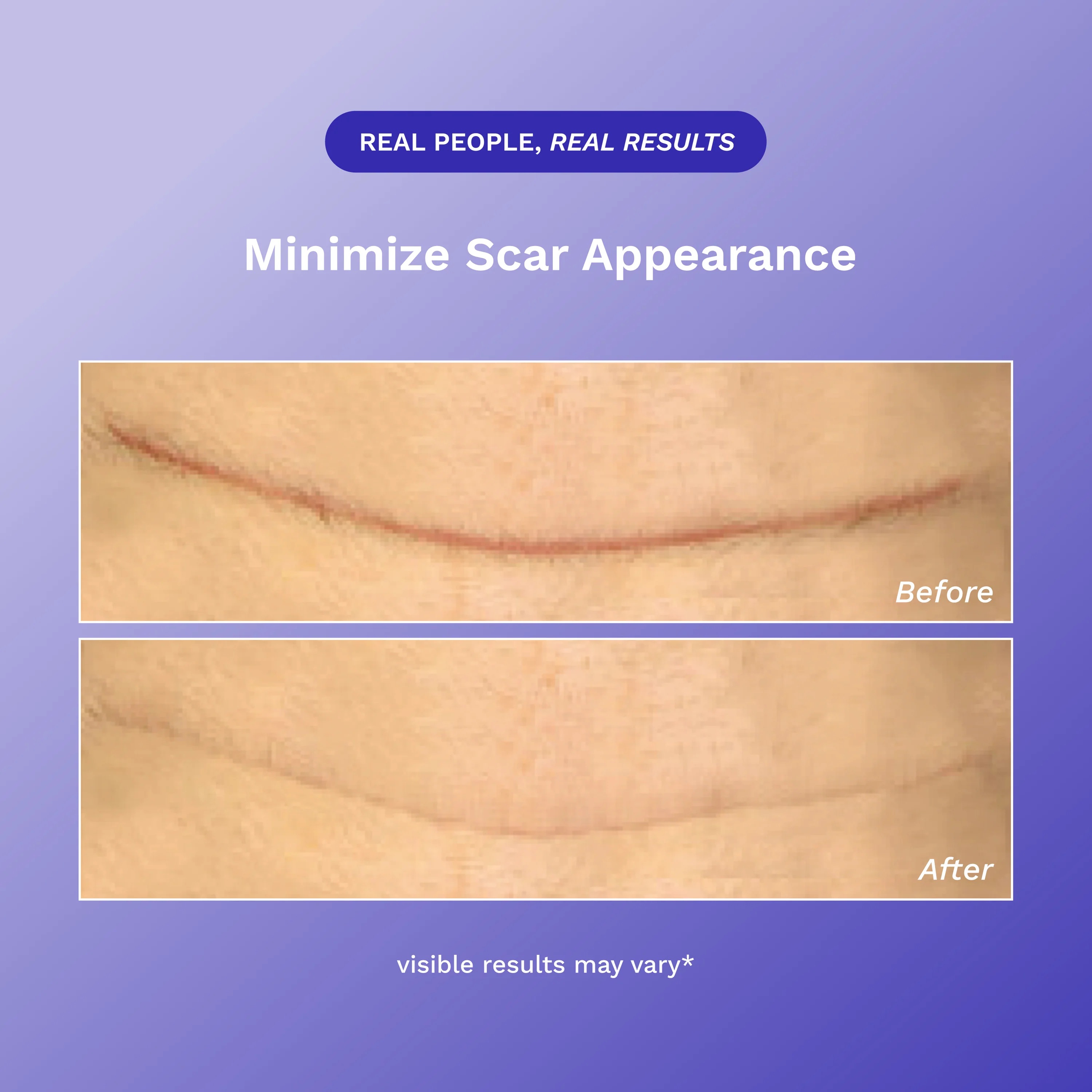 Rejuvaskin® Scar Heal® Scar Management Kit – 1 x 3 x 5 Inch Silicone Strip, Non-Sterile-EA