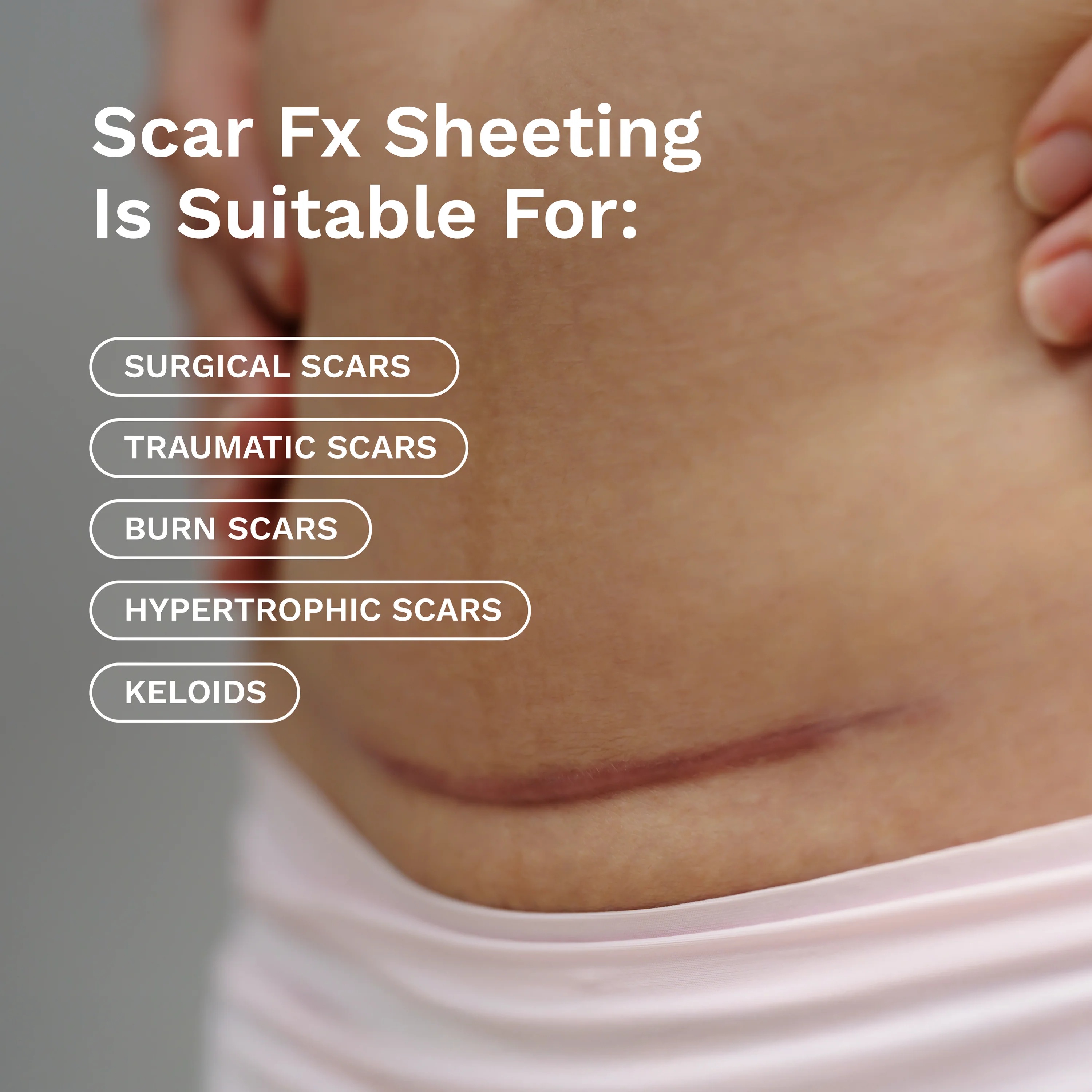 Scar Management Kit Rejuvaskin®Scar Heal® 1 X 12 Inch Strip NonSterile